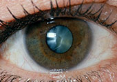 Detalle de un ojo iluminado para evaluación de cataratas