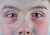 Detalle de ojo para evaluación de conjuntivitis